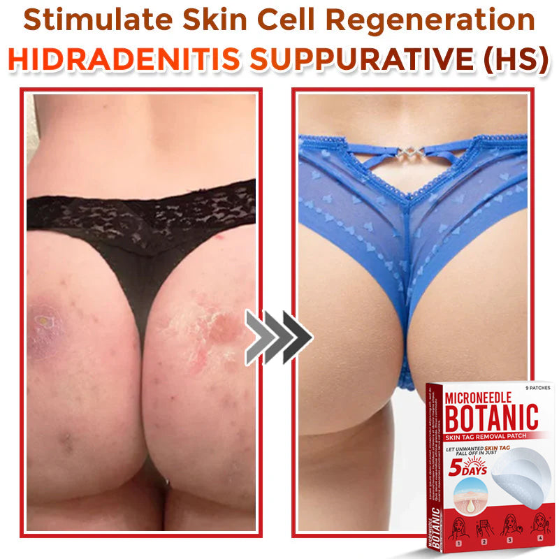 Microneedle Botanical Skin Tag Removal Patch 🇺🇸Made in the USA (FDA Certified)