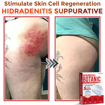 Microneedle Botanical Skin Tag Removal Patch 🇺🇸Made in the USA (FDA Certified)